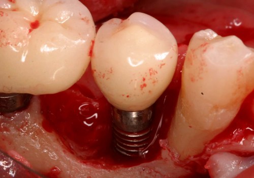 When is a dental implant not recommended?