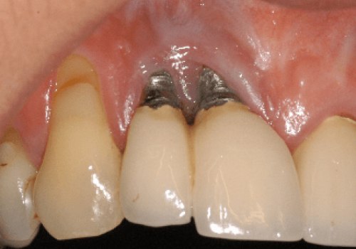 Can a dental implant cause problems years later?