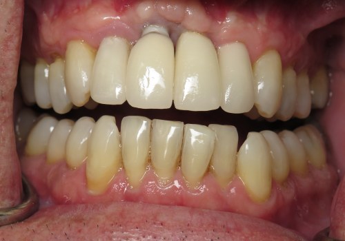 When are dental implants not a good idea?
