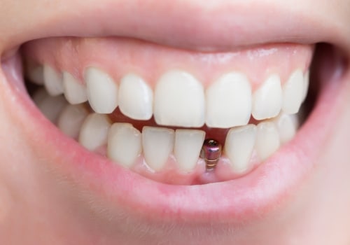 At what stage do dental implants fail?
