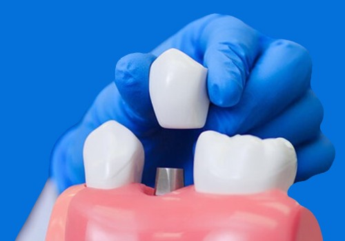 Do dental implants feel strange at first?
