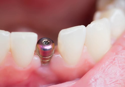 What are the chances of the implant failing?