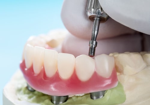 What is the biggest reason implants fail?