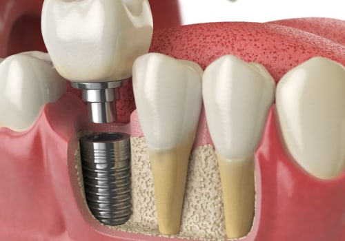 How painful is implant insertion?