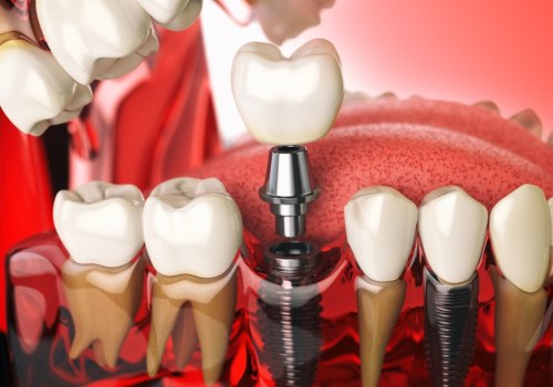 What is the best painkiller for dental implants?