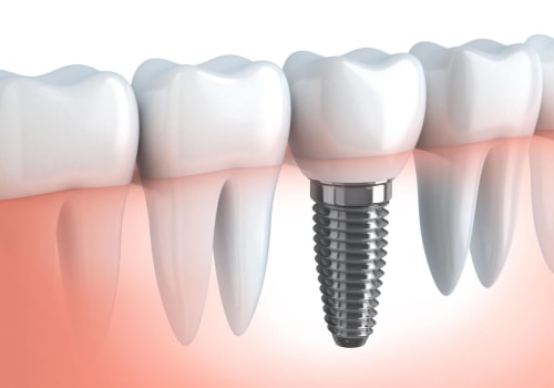 How long is the pain after a dental implant?