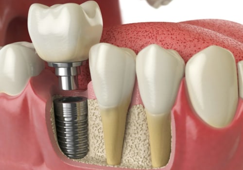 What are dental implants and how do they work?
