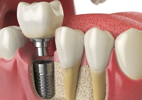 How long does a dental implant last?