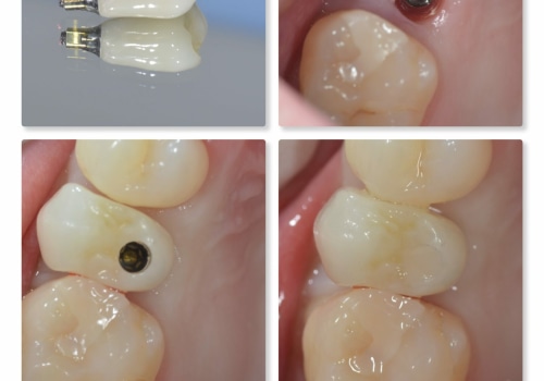 What is the first step in the dental implant process?