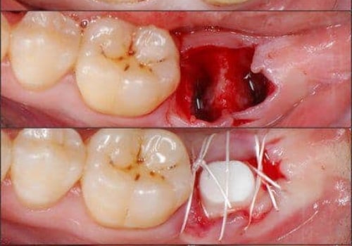 How long does it take for a dental implant to stop hurting?