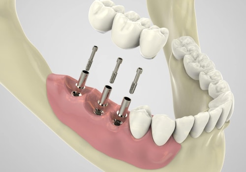 Steps Involved in Full Mouth Implant Placement