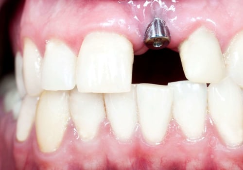 When do most dental implants fail?