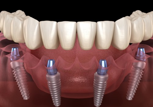 Requirements for Full Mouth Implants: A Comprehensive Guide