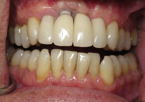 Why not to get dental implants?