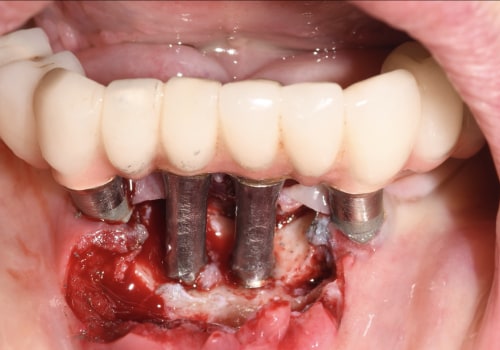 What are the most common problems with dental implants?