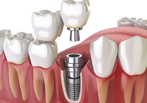 Understanding Follow-Up Care for Dental Implants