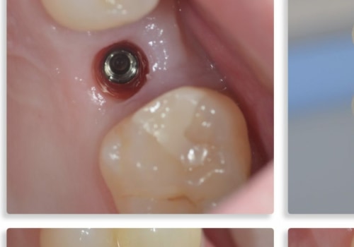 What does the first stage of a dental implant look like?