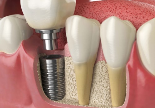 How long does the first step of a dental implant take?