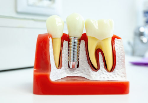 What is the most painful part of getting a dental implant?