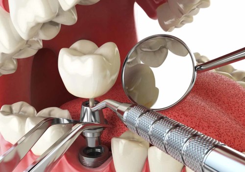 What is the best age to get dental implants?
