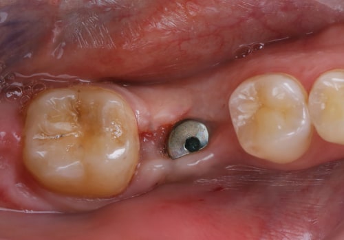 Understanding the Recovery Process and Timeline for Dental Implants