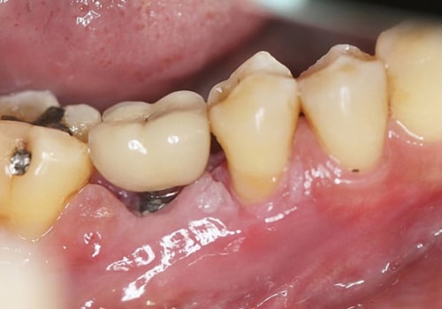 What is the downside of having teeth implants?