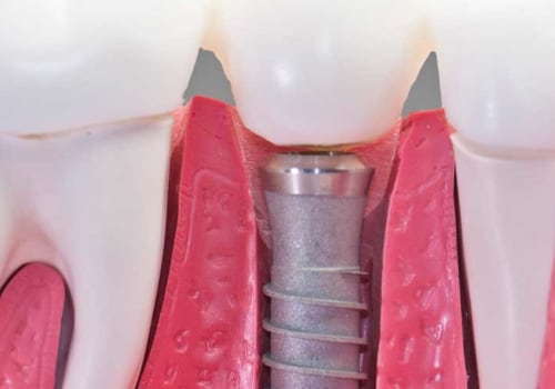 What percent of dental implants are rejected?