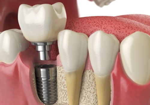 How common are problems with dental implants?