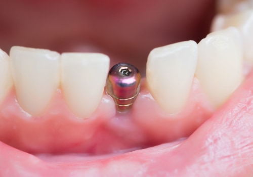 How long does it take to put in the screw for a dental implant?
