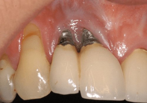 What is the negative to getting dental implants?