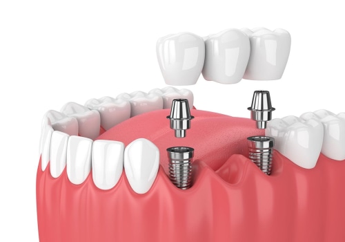 What are the 3 types of dental implants?