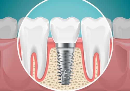 Which oral site has the highest implant failure rate?