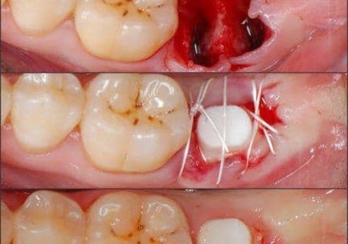 How long is your mouth sore after a dental implant?