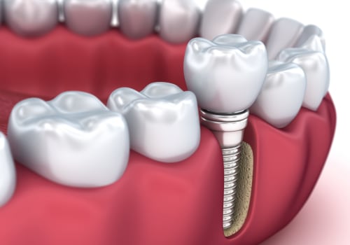 Are implants more painful than root canals?