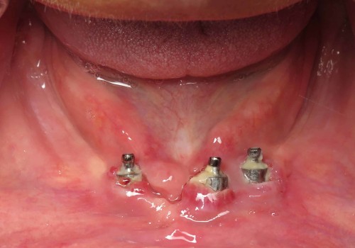 How can you tell if a dental implant is going bad?