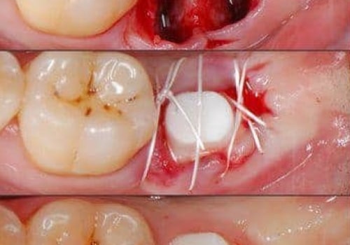 What is the pain level for dental implants?